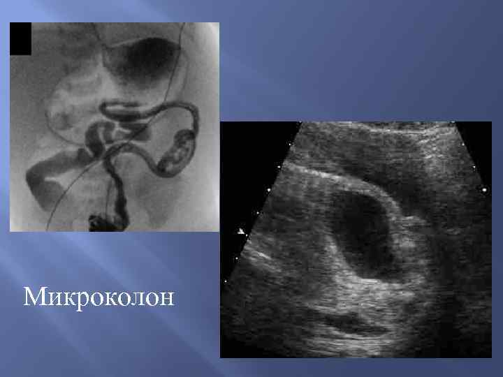 Микроколон 