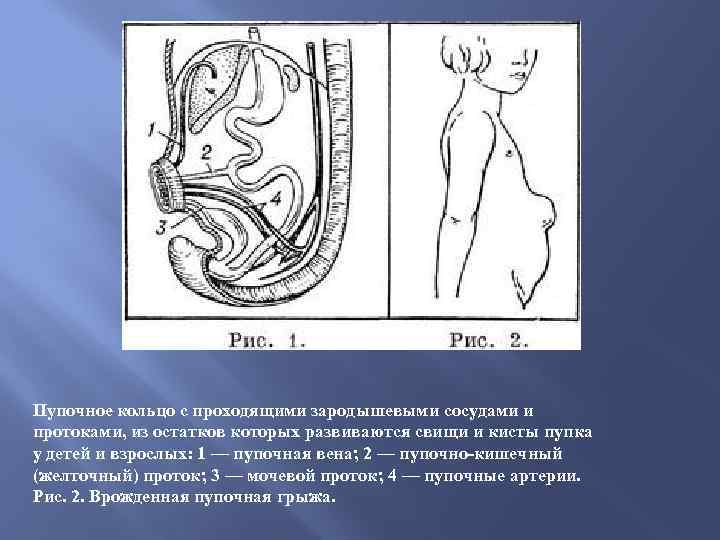 Пупочное кольцо с проходящими зародышевыми сосудами и протоками, из остатков которых развиваются свищи и