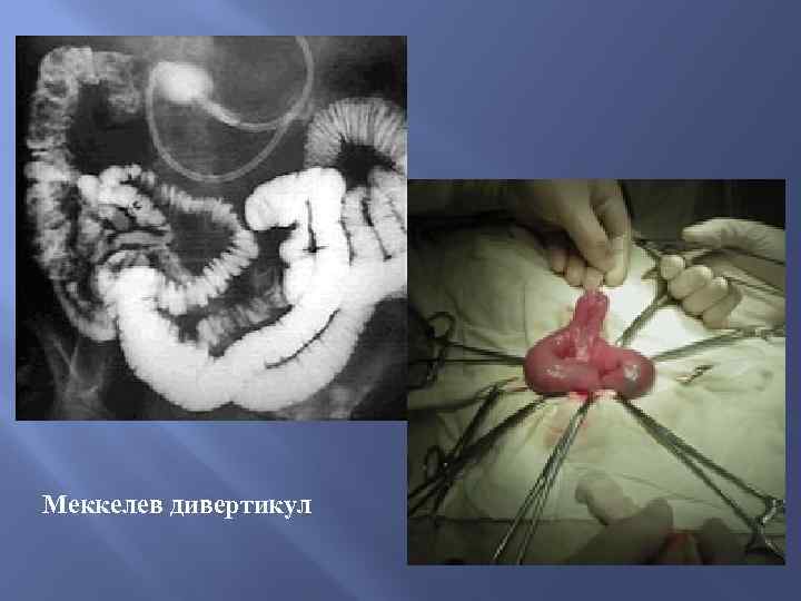 Меккелев дивертикул 