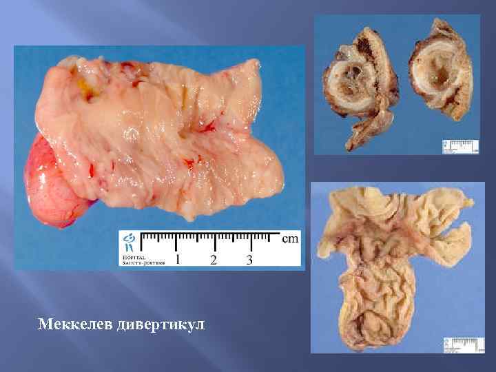 Меккелев дивертикул 
