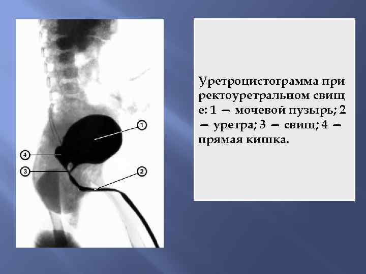 Уретроцистограмма при ректоуретральном свищ е: 1 — мочевой пузырь; 2 — уретра; 3 —