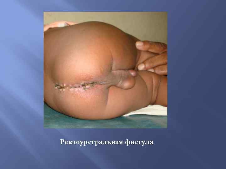 Ректоуретральная фистула 
