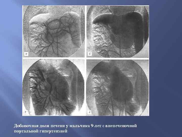 Добавочная доля печени у мальчика 9 лет с внепеченочной портальной гипертензией 