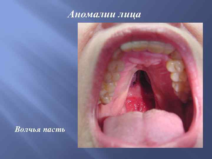 Аномалии лица Волчья пасть 