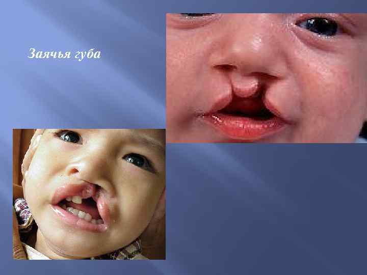 Заячья губа 