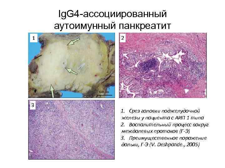 Ig. G 4 -ассоциированный аутоимунный панкреатит 1 3 2 1. Срез головки поджелудочной железы