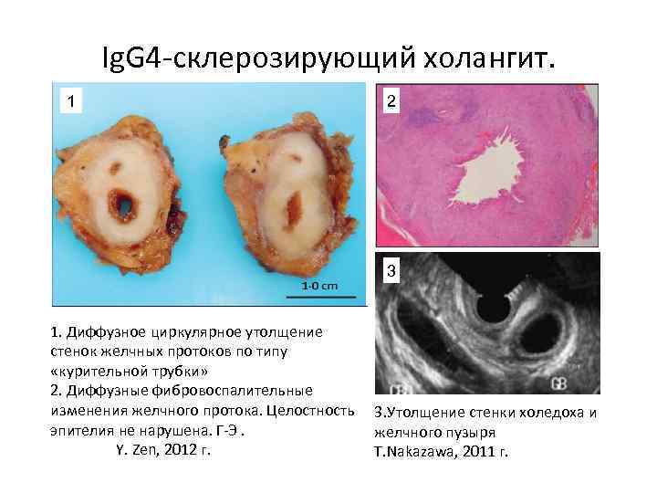 Ig. G 4 -склерозирующий холангит. 1 2 3 1. Диффузное циркулярное утолщение стенок желчных