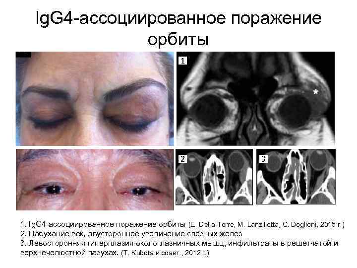 Ig. G 4 -ассоциированное поражение орбиты 1 2 3 1. Ig. G 4 -ассоциированное