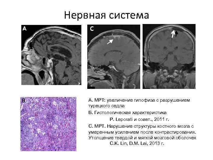 Нервная система С А. МРТ: увеличение гипофиза с разрушением турецкого седла В. Гистологическая характеристика