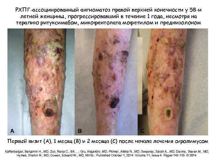 РХПГ-ассоциированный ангиоматоз правой верхней конечности у 58 -и летней женщины, прогрессировавший в течение 1