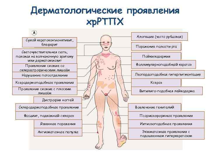 Дерматологические проявления хр. РТПХ Сухой кератоконъюнктивит, блефарит Светочувствительная сыпь, похожая на волчаночную эритему или