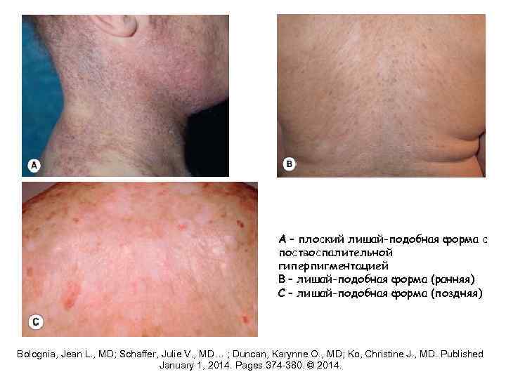 A – плоский лишай-подобная форма с поствоспалительной гиперпигментацией B – лишай-подобная форма (ранняя) C