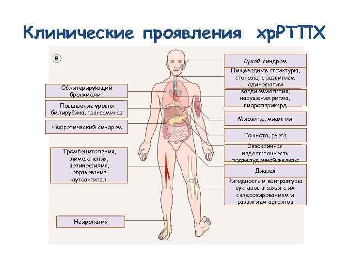 Клинические проявления хр. РТПХ Сухой синдром Облитерирующий бронхиолит Повышение уровня билирубина, трансаминаз Пищеводные стриктуры,