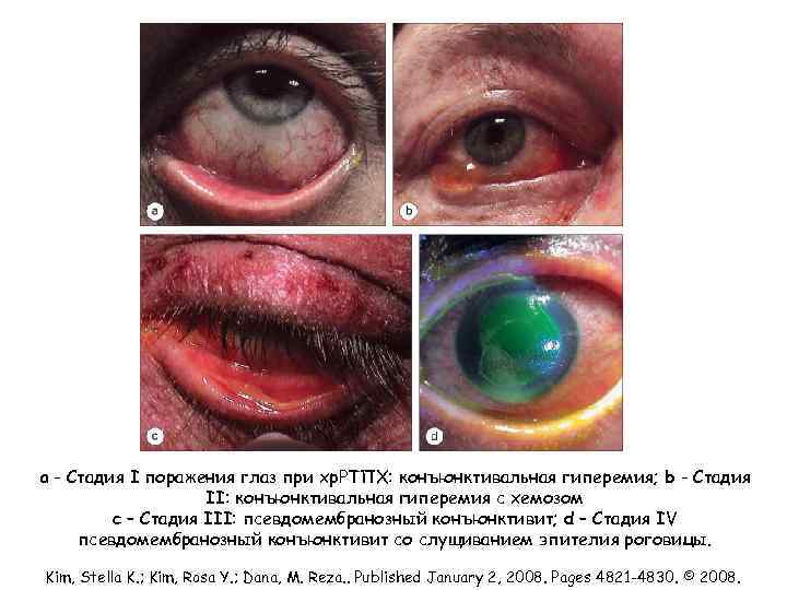 a - Стадия I поражения глаз при хр. РТПХ: конъюнктивальная гиперемия; b - Стадия