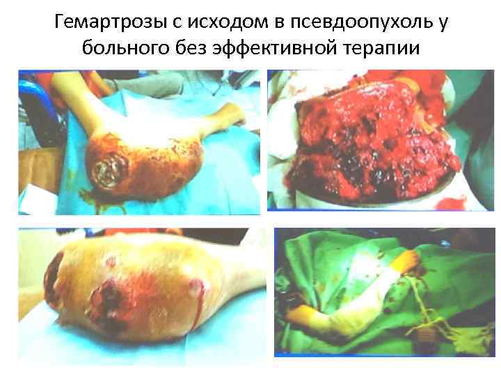 Гемартрозы с исходом в псевдоопухоль у больного без эффективной терапии 