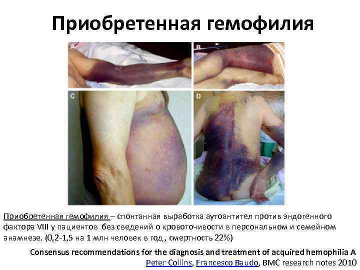 Приобретенная гемофилия – спонтанная выработка аутоантител против эндогенного фактора VIII у пациентов без сведений