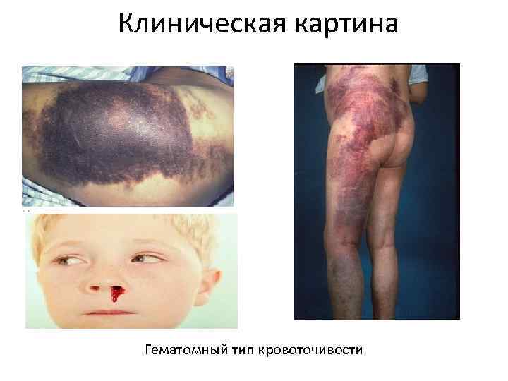 Клиническая картина Гематомный тип кровоточивости 