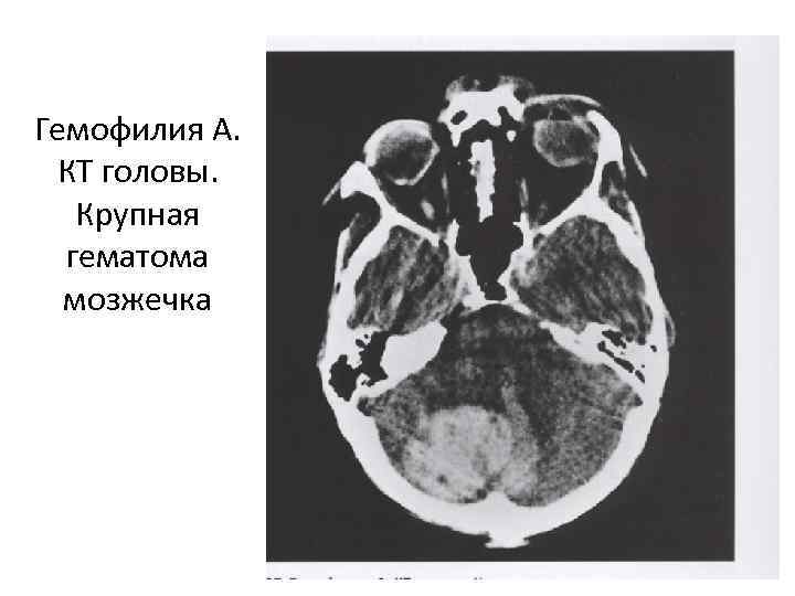 Гемофилия А. КТ головы. Крупная гематома мозжечка 