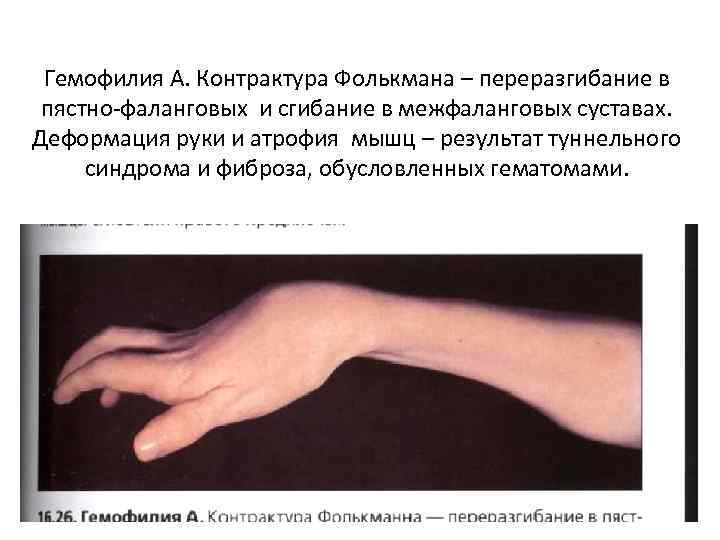 Гемофилия А. Контрактура Фолькмана – переразгибание в пястно-фаланговых и сгибание в межфаланговых суставах. Деформация
