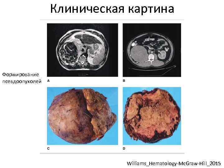 Клиническая картина Формирование псевдоопухолей Williams_Hematology-Mc. Graw-Hill_2015 