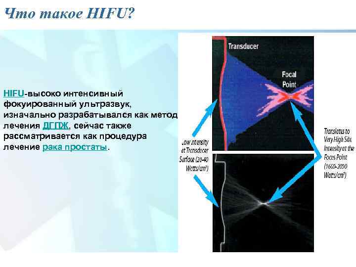 Что такое HIFU? HIFU-высоко интенсивный фокуированный ультразвук, изначально разрабатывался как метод лечения ДГПЖ, сейчас