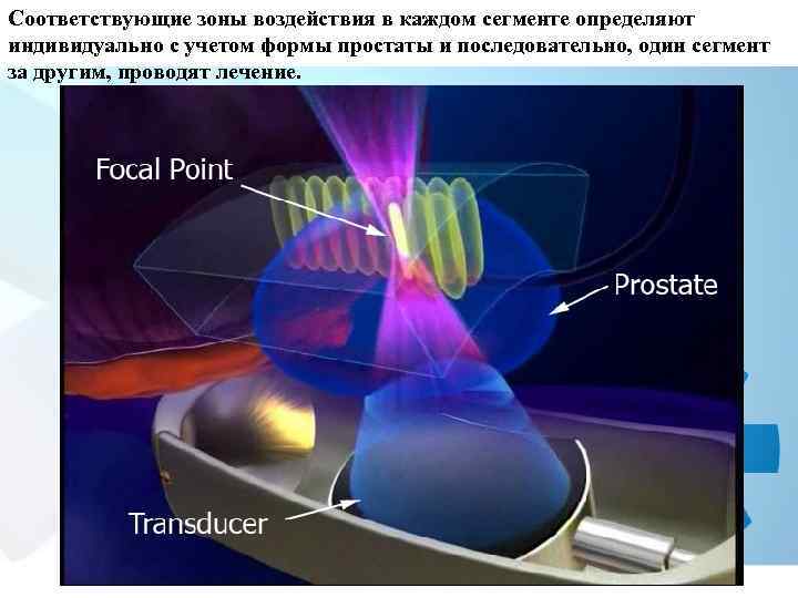 Соответствующие зоны воздействия в каждом сегменте определяют индивидуально с учетом формы простаты и последовательно,