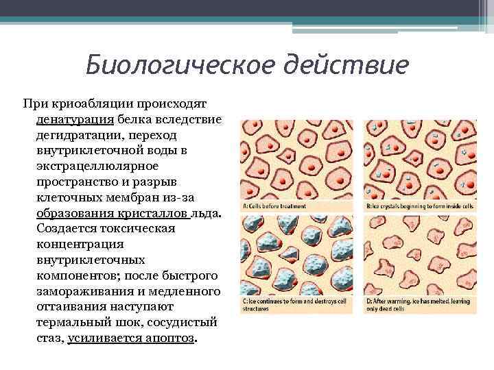 Биологическое действие При криоабляции происходят денатурация белка вследствие дегидратации, переход внутриклеточной воды в экстрацеллюлярное