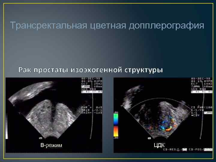 Подготовка к трузи предстательной железы. Средняя доля предстательной железы на УЗИ. Допплерография предстательной железы. Изоэхогенный узел предстательной железы.