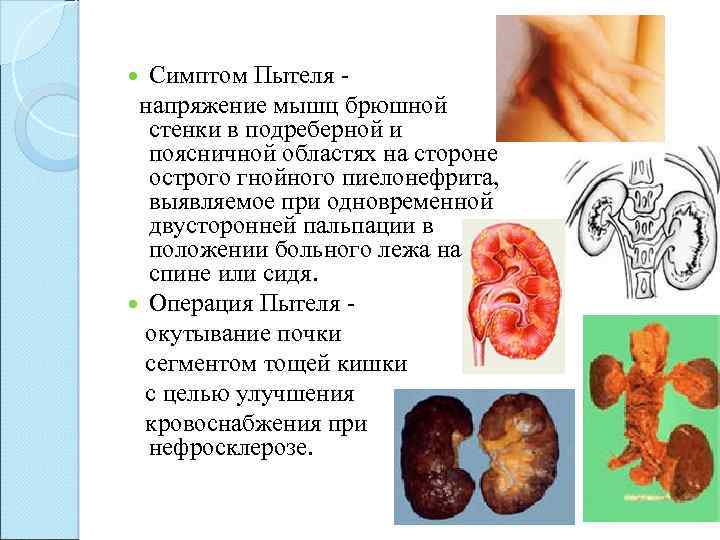 Симптом Пытеля - напряжение мышц брюшной стенки в подреберной и поясничной областях на стороне