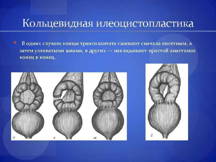 Кольцевидная илеоцистопластика В одних случаях концы трансплантата сшивают сначала кисетным, а затем узловатыми швами,