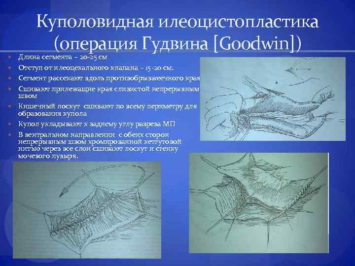  Куполовидная илеоцистопластика (операция Гудвина [Goodwin]) Длина сегмента – 20 -25 см Отступ от