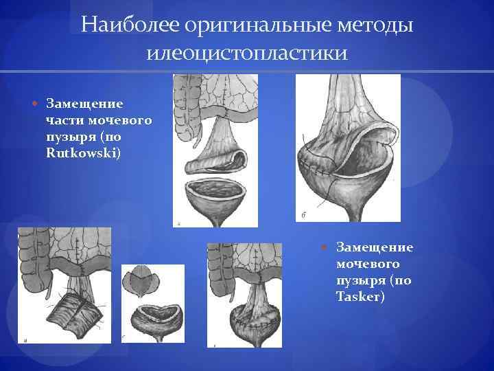 Наиболее оригинальные методы илеоцистопластики Замещение части мочевого пузыря (по Rutkowski) Замещение мочевого пузыря (по