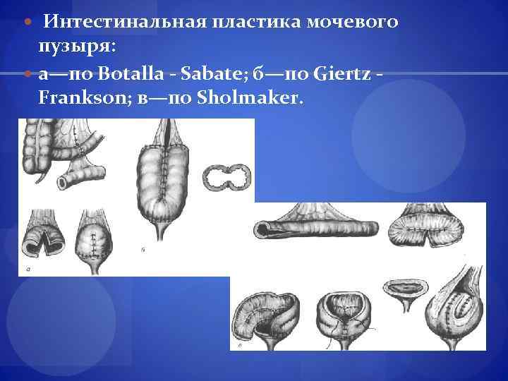  Интестинальная пластика мочевого пузыря: а—по Botalla - Sabate; б—по Giertz - Frankson; в—по