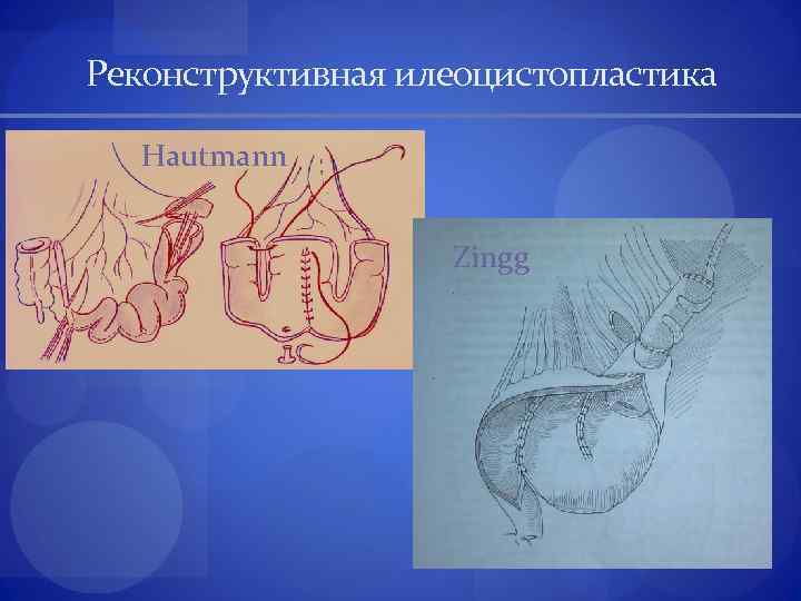 Реконструктивная илеоцистопластика Hautmann Zingg 