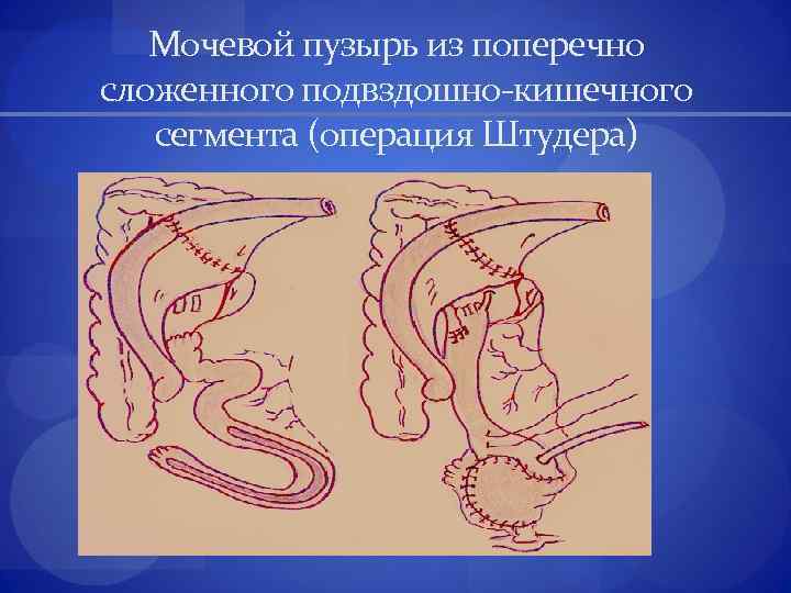 Кишечный мочевой пузырь. Операция Штудера техника. Ортотопическая пластика мочевого пузыря. Пластика мочевого пузыря по Штудеру.