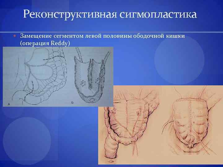 Реконструктивная сигмопластика Замещение сегментом левой половины ободочной кишки (операция Reddy) 