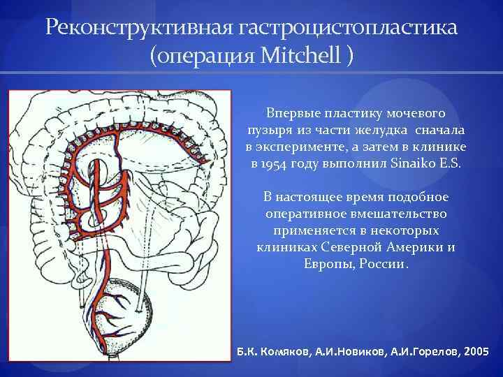 Реконструктивная гастроцистопластика (операция Mitchell ) Впервые пластику мочевого пузыря из части желудка сначала в