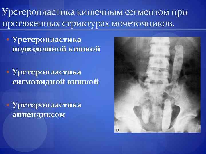 Уретеропластика кишечным сегментом при протяженных стриктурах мочеточников. Уретеропластика подвздошной кишкой Уретеропластика сигмовидной кишкой Уретеропластика