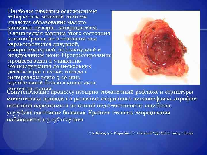 Наиболее тяжелым осложнением туберкулеза мочевой системы является образование малого мочевого пузыря – микроцистиса. Клиническая