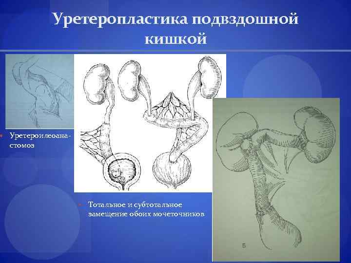 Уретеропластика подвздошной кишкой Уретероилеоана- стомоз Тотальное и субтотальное замещение обоих мочеточников 