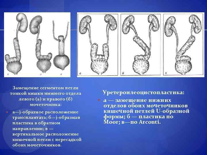 Замещение сегментом петли тонкой кишки нижнего отдела левого (а) и правого (б) мочеточника: a—j-образное