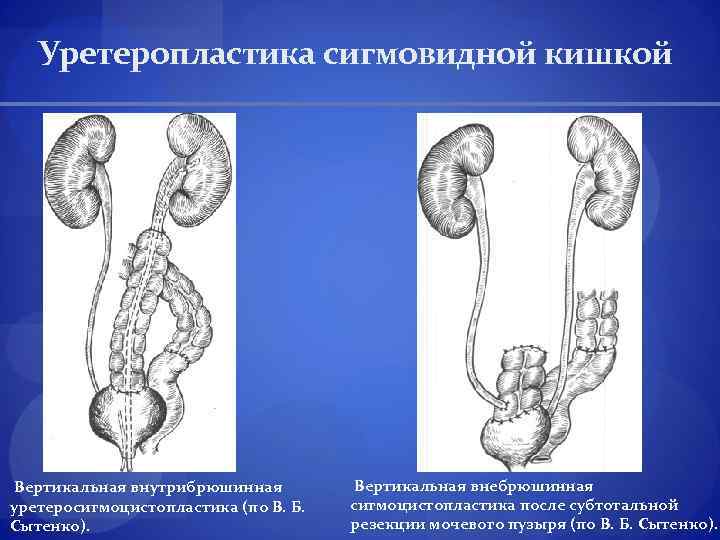 Уретеропластика сигмовидной кишкой Вертикальная внутрибрюшинная уретеросигмоцистопластика (по В. Б. Сытенко). Вертикальная внебрюшинная сигмоцистопластика после