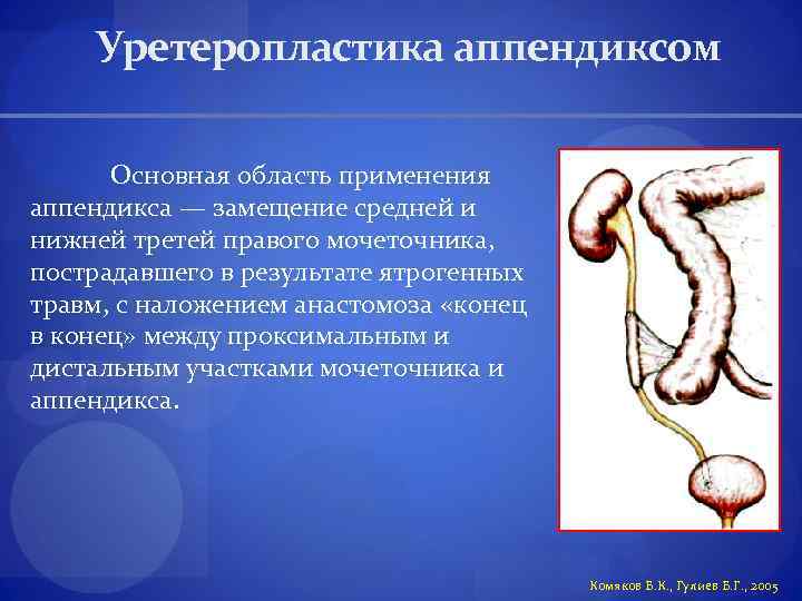 Уретеропластика аппендиксом Основная область применения аппендикса — замещение средней и нижней третей правого мочеточника,