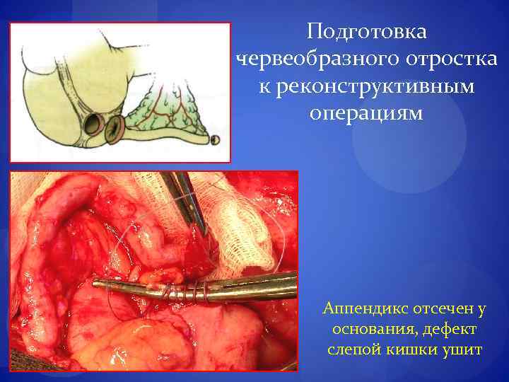 Подготовка червеобразного отростка к реконструктивным операциям Аппендикс отсечен у основания, дефект слепой кишки ушит