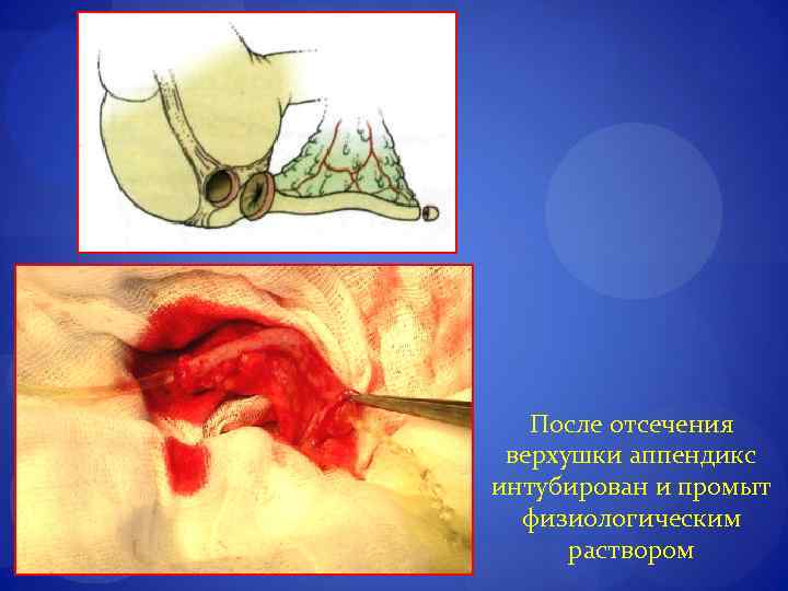 После отсечения верхушки аппендикс интубирован и промыт физиологическим раствором 