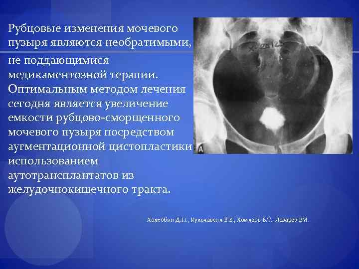 Рубцовые изменения мочевого пузыря являются необратимыми, не поддающимися медикаментозной терапии. Оптимальным методом лечения сегодня