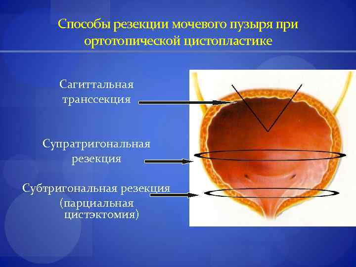 Способы резекции мочевого пузыря при ортотопической цистопластике Сагиттальная транссекция Супратригональная резекция Субтригональная резекция (парциальная