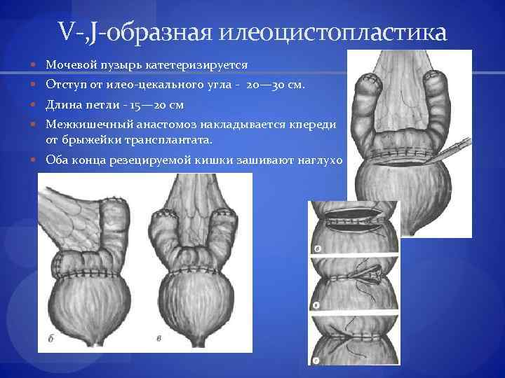 V-, J-образная илеоцистопластика Мочевой пузырь катетеризируется Отступ от илео-цекального угла - 20— 30 см.