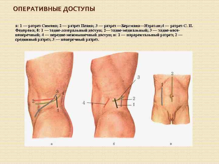 ОПЕРАТИВНЫЕ ДОСТУПЫ а: 1 — разрез Симона; 2 — разрез Пеана; 3 — разрез