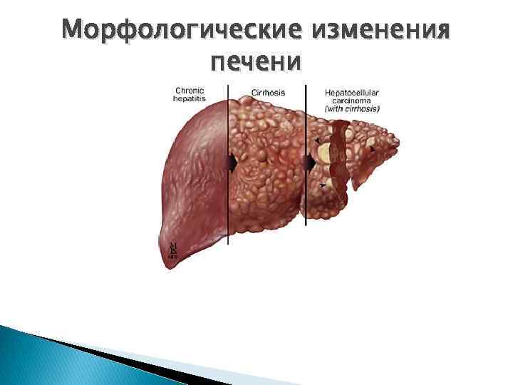 Морфологические изменения печени 